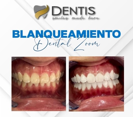 balnqueamiento dental zom