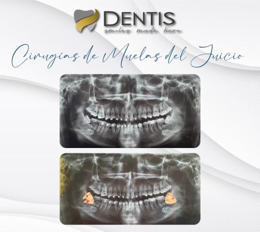 muelas de juicio