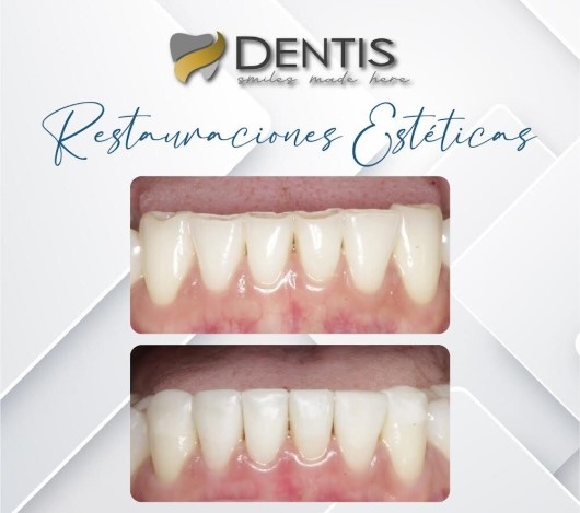 restauraciones esteticas